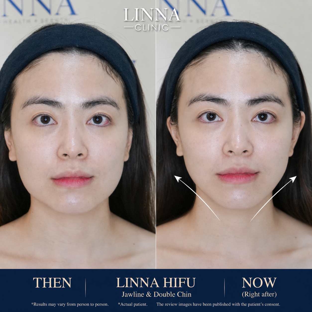 LINNA Clinic treatment result