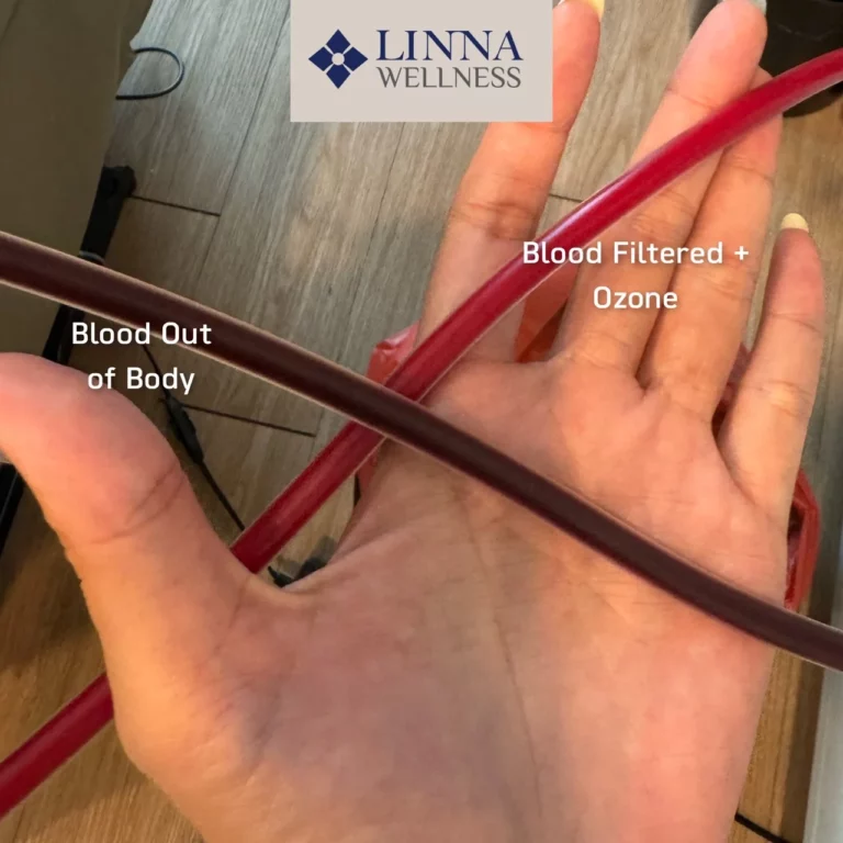 Ozone Therapy (EBOO PLUS Technique) at LINNA Clinic