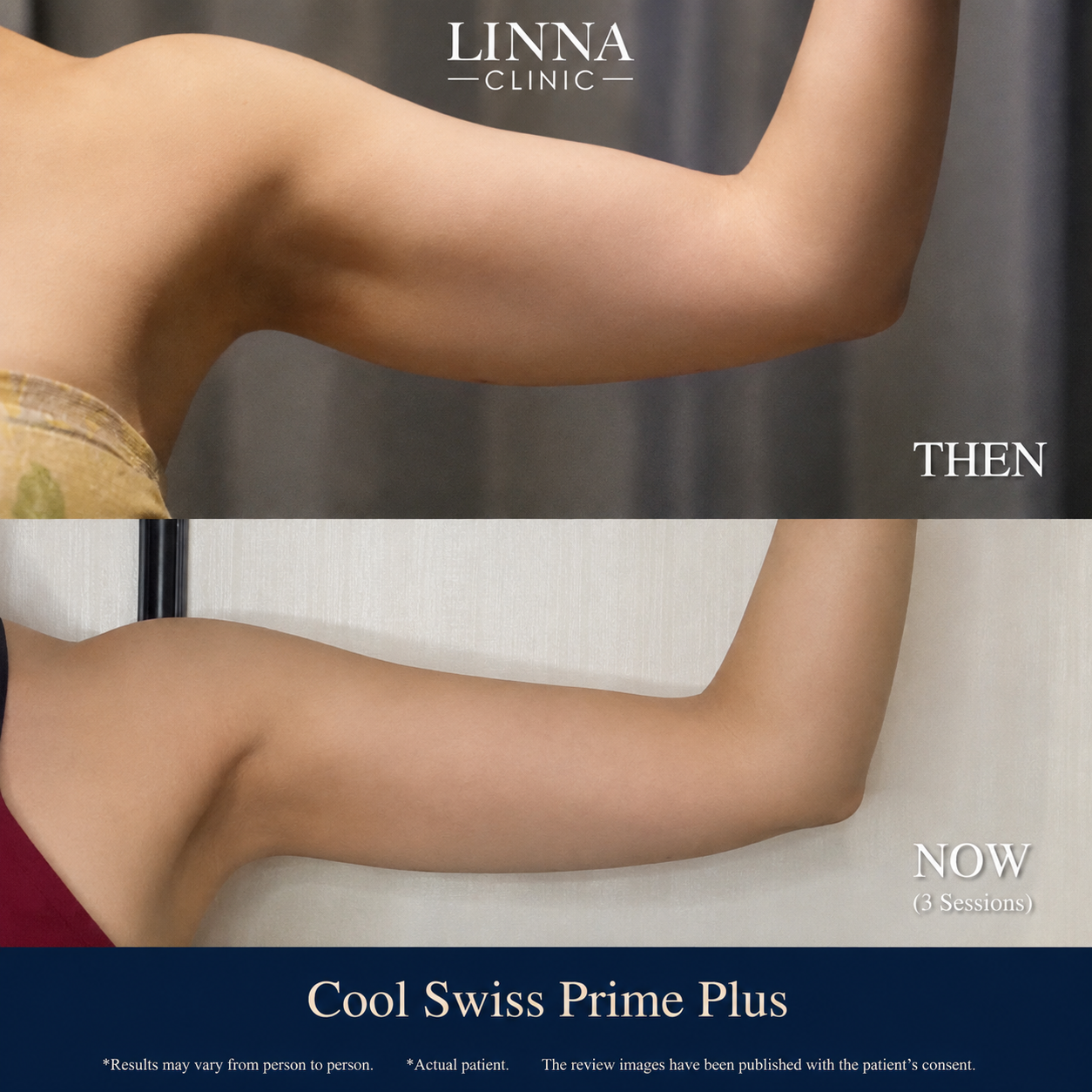 Cool Swiss Prime Plus before and after