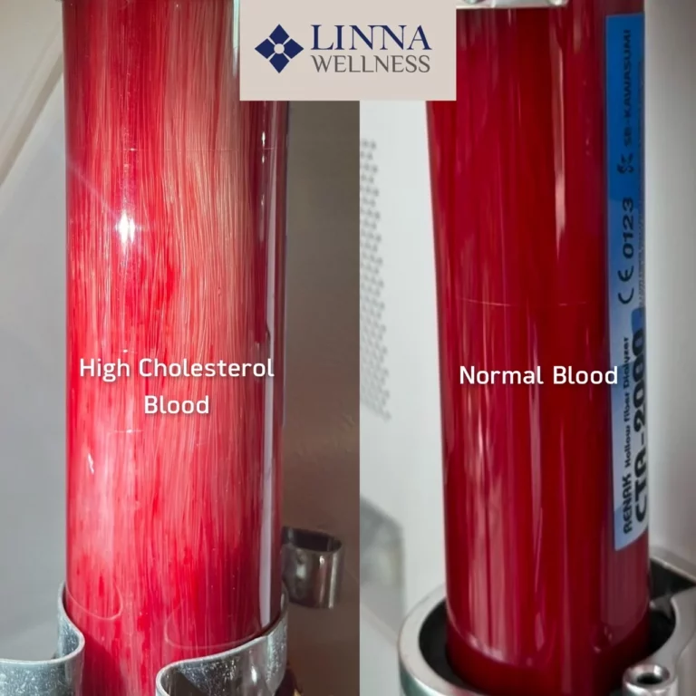 Ozone Therapy (EBOO PLUS Technique) at LINNA Clinic