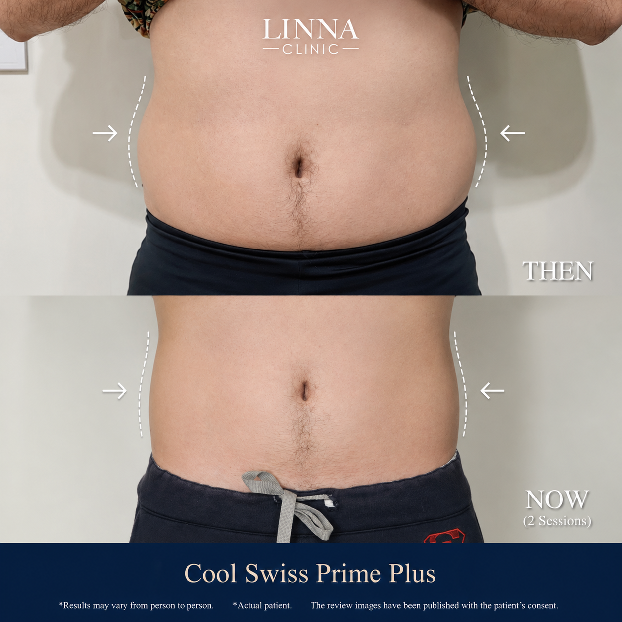 Cool Swiss Prime Plus before and after