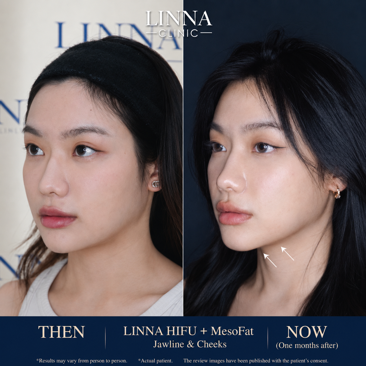LINNA Clinic treatment result