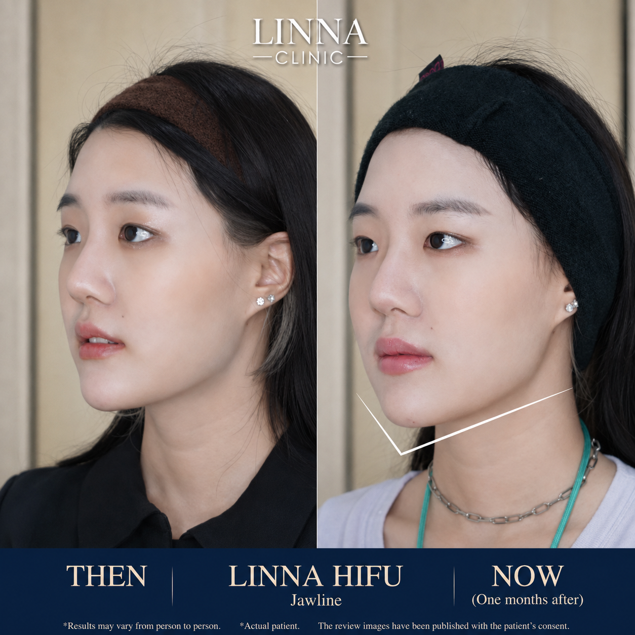 LINNA Clinic treatment result