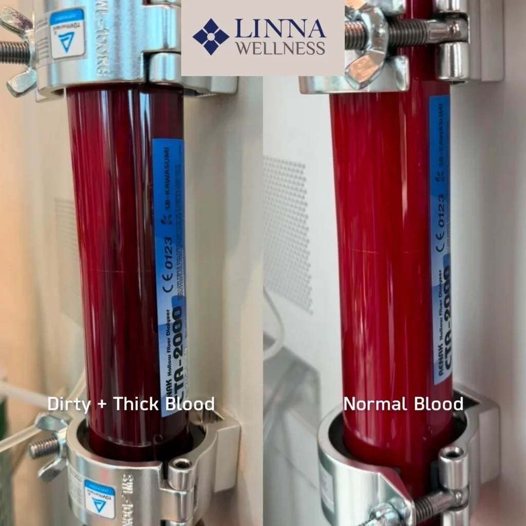 Ozone Therapy (EBOO PLUS Technique) at LINNA Clinic