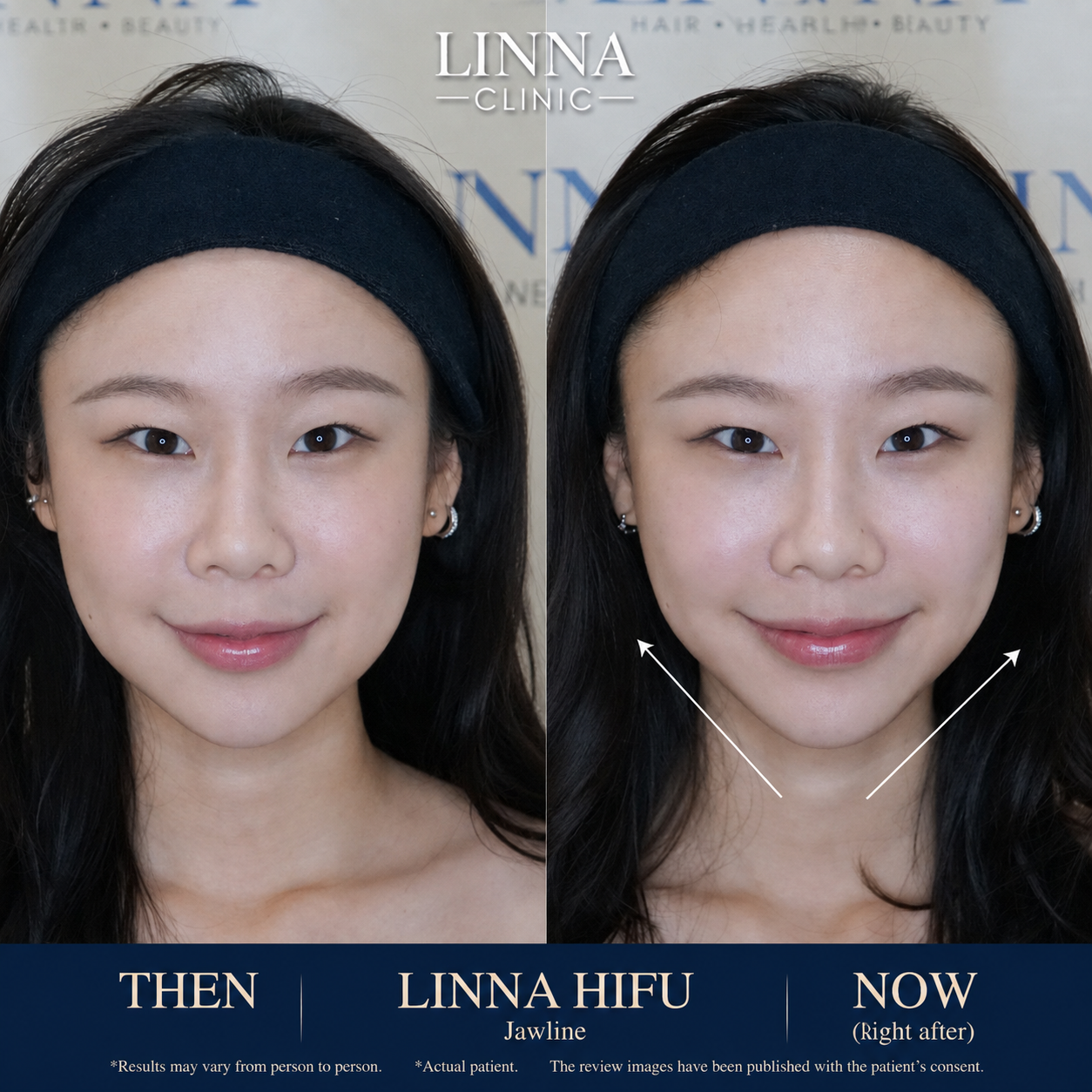 LINNA Clinic treatment result