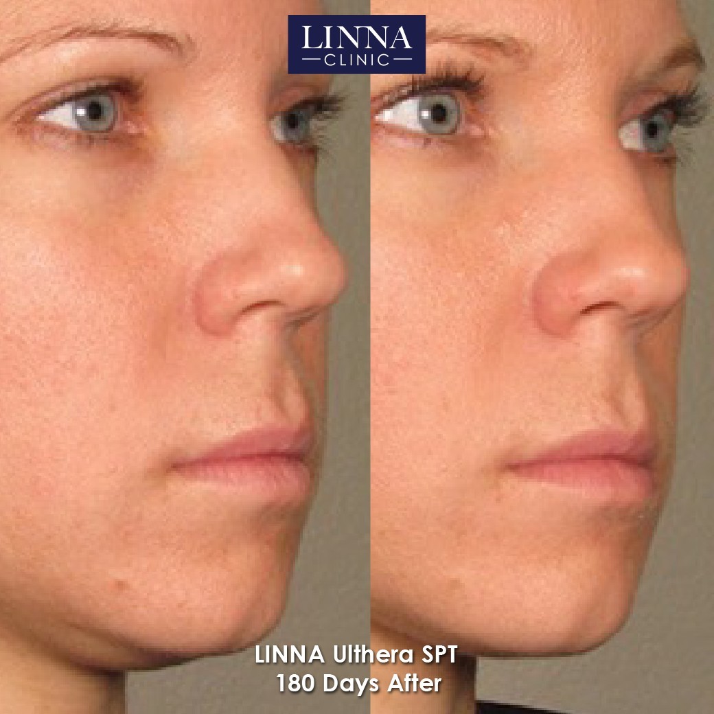 LINNA Ulthera SPT before and after result