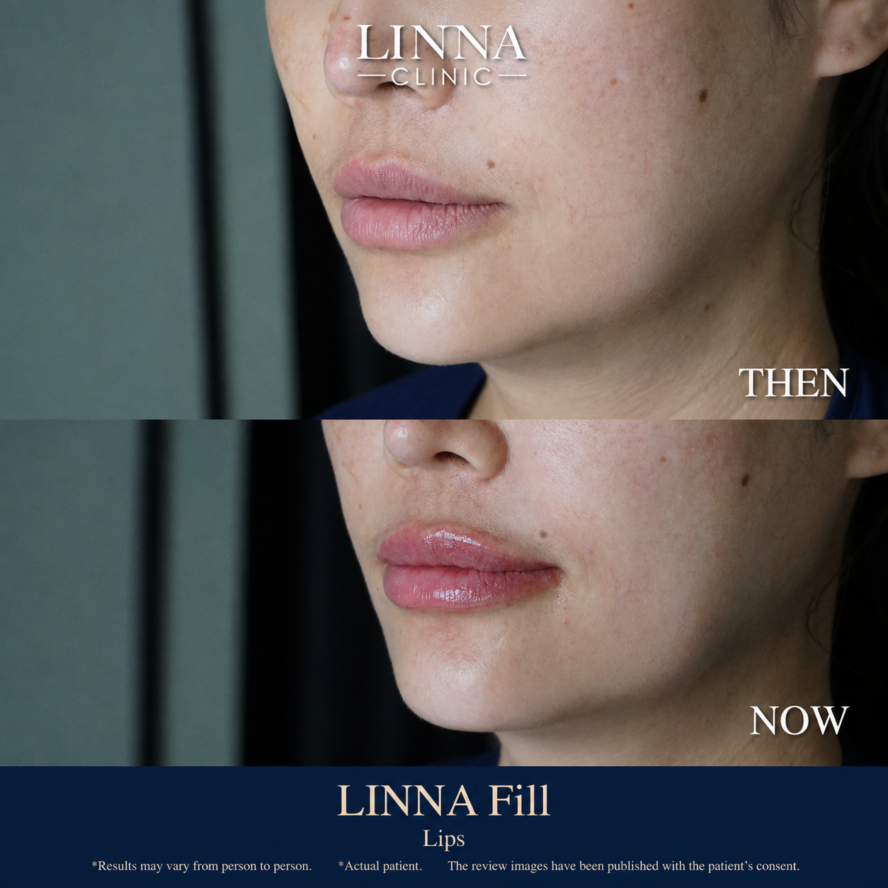Lip filler before and after at LINNA Clinic
