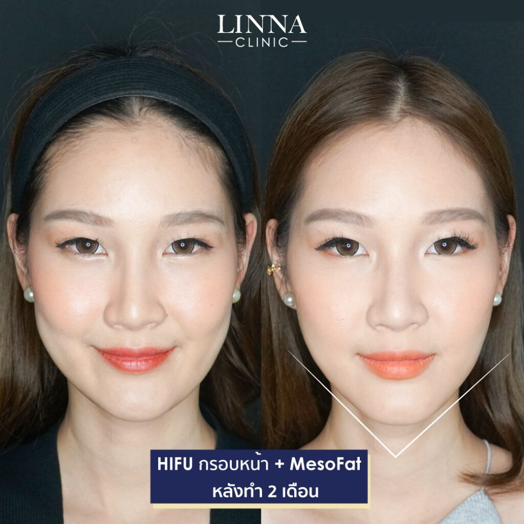 Dr. Phrutphailin Tantisinlaphong, M.D. — 1