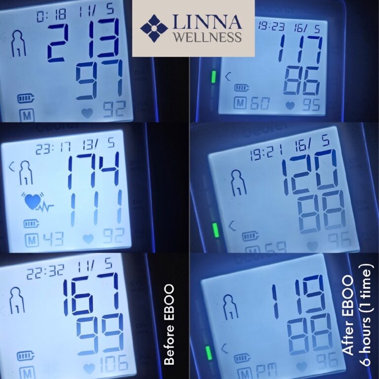 Ozone Therapy (EBOO PLUS Technique) at LINNA Clinic