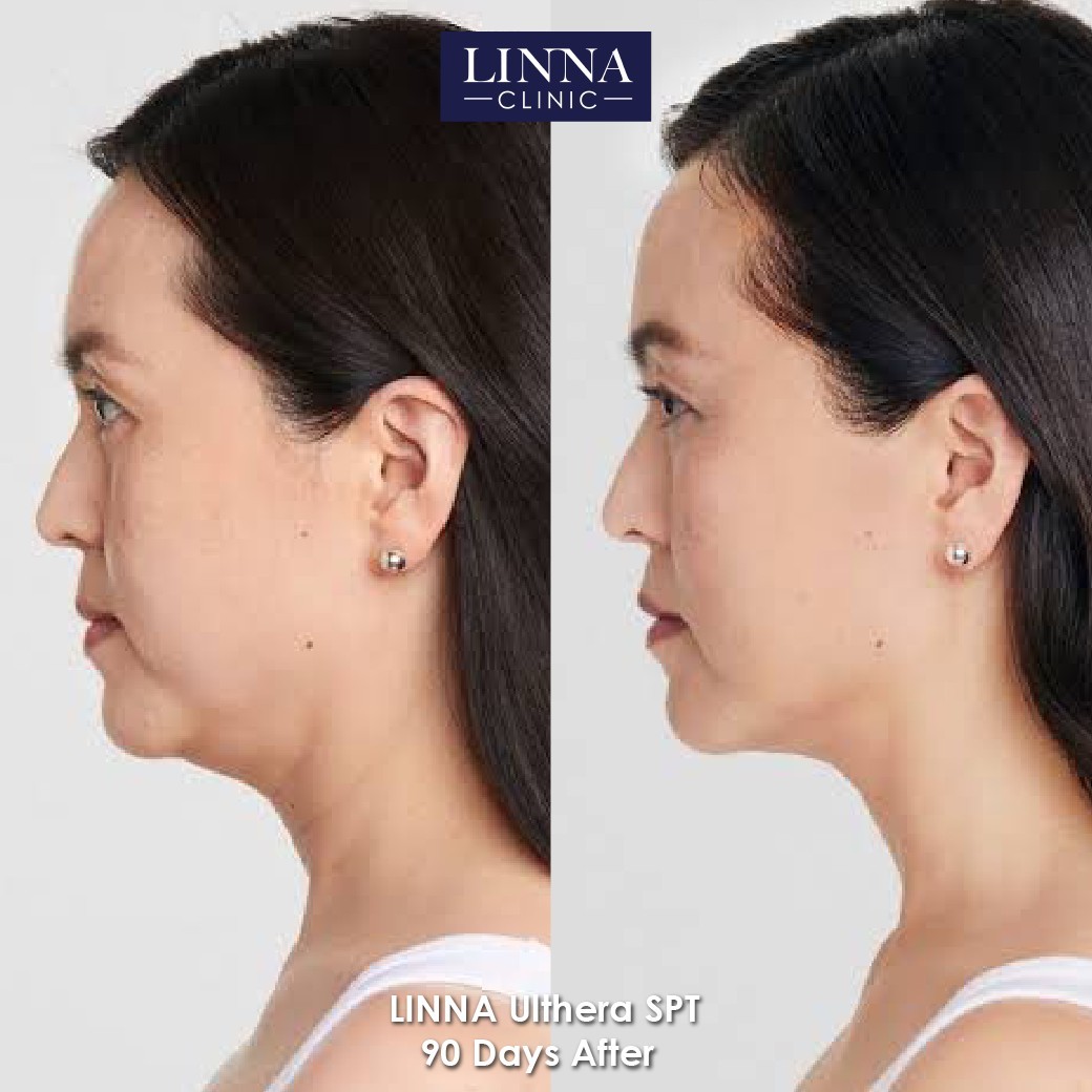 LINNA Ulthera SPT before and after result