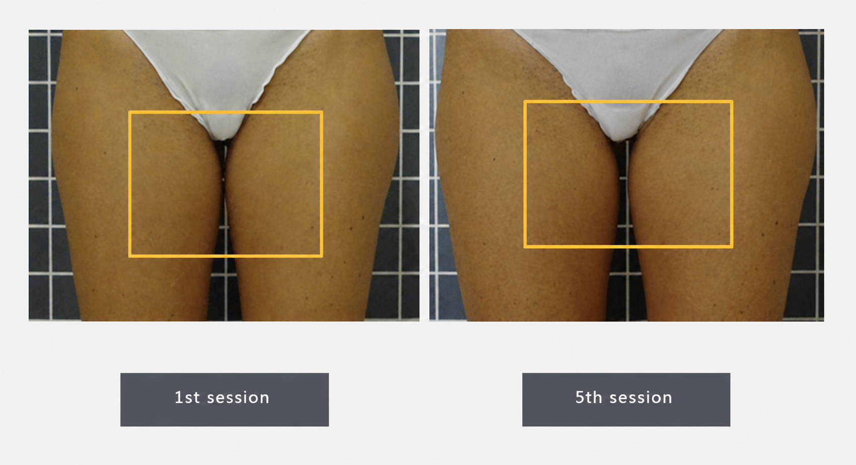 LINNA Body Sculpting by iCOONE® before and after 1st and 5th session