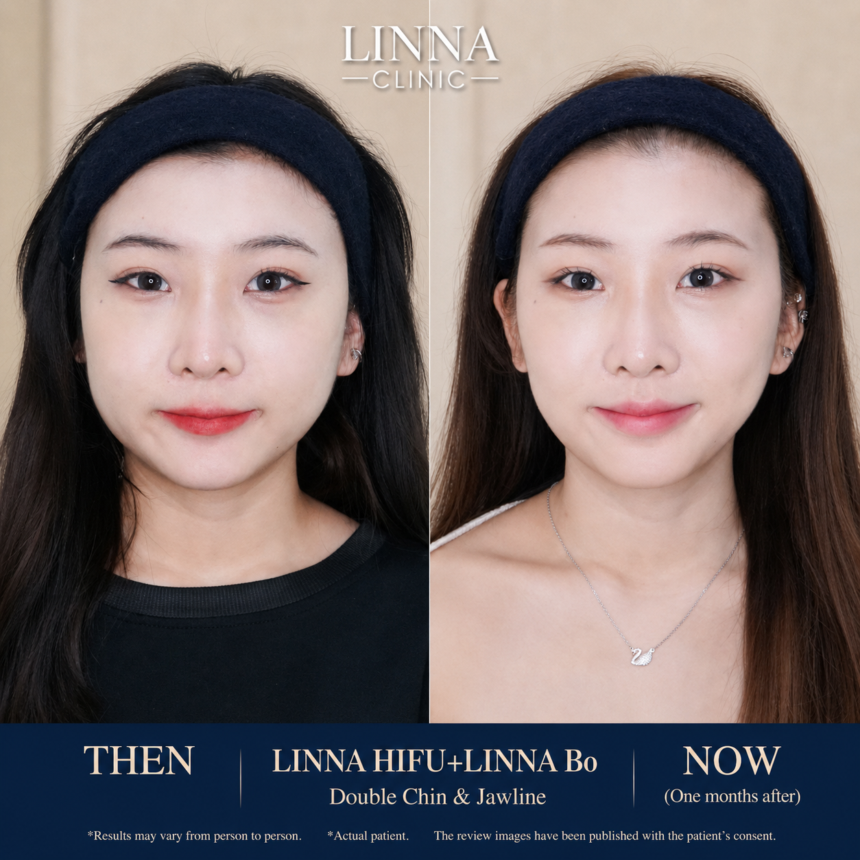 LINNA Clinic โปรแกรมโบ ช่วยลดริ้วรอย ปรับรูปหน้าและรูปคิ้ว ไม่มีผลข้างเคียงและไม่ทิ้งสารตกค้างภายในร่างกาย