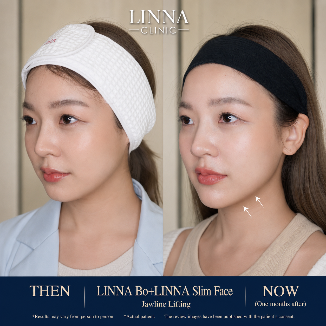LINNA Clinic โปรแกรมโบ ช่วยลดริ้วรอย ปรับรูปหน้าและรูปคิ้ว ไม่มีผลข้างเคียงและไม่ทิ้งสารตกค้างภายในร่างกาย