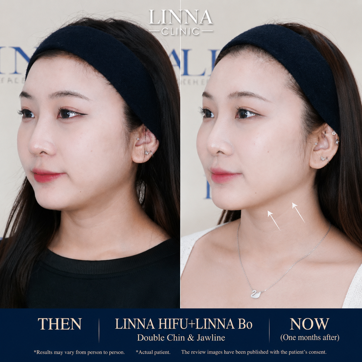 LINNA Clinic โปรแกรมโบ ช่วยลดริ้วรอย ปรับรูปหน้าและรูปคิ้ว ไม่มีผลข้างเคียงและไม่ทิ้งสารตกค้างภายในร่างกาย