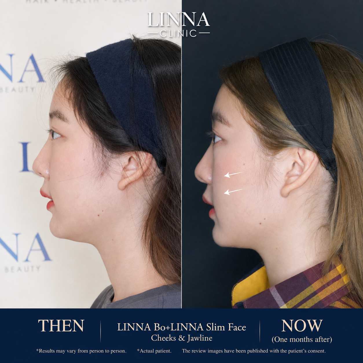 LINNA Clinic โปรแกรมโบ ช่วยลดริ้วรอย ปรับรูปหน้าและรูปคิ้ว ไม่มีผลข้างเคียงและไม่ทิ้งสารตกค้างภายในร่างกาย