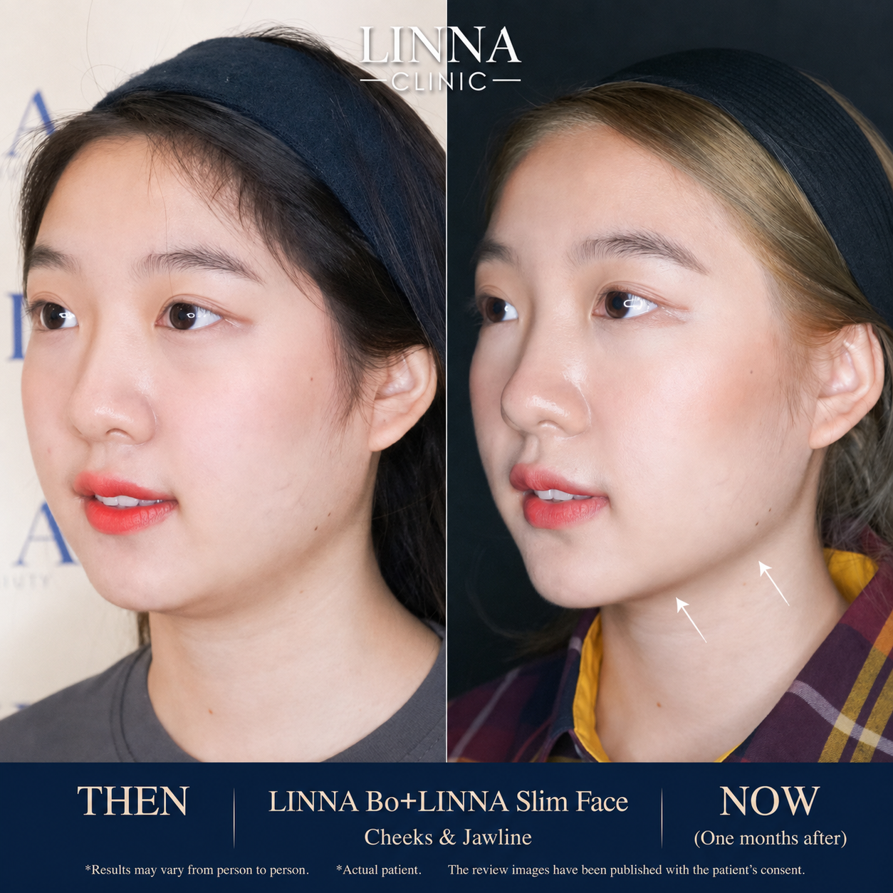 LINNA Clinic โปรแกรมโบ ช่วยลดริ้วรอย ปรับรูปหน้าและรูปคิ้ว ไม่มีผลข้างเคียงและไม่ทิ้งสารตกค้างภายในร่างกาย