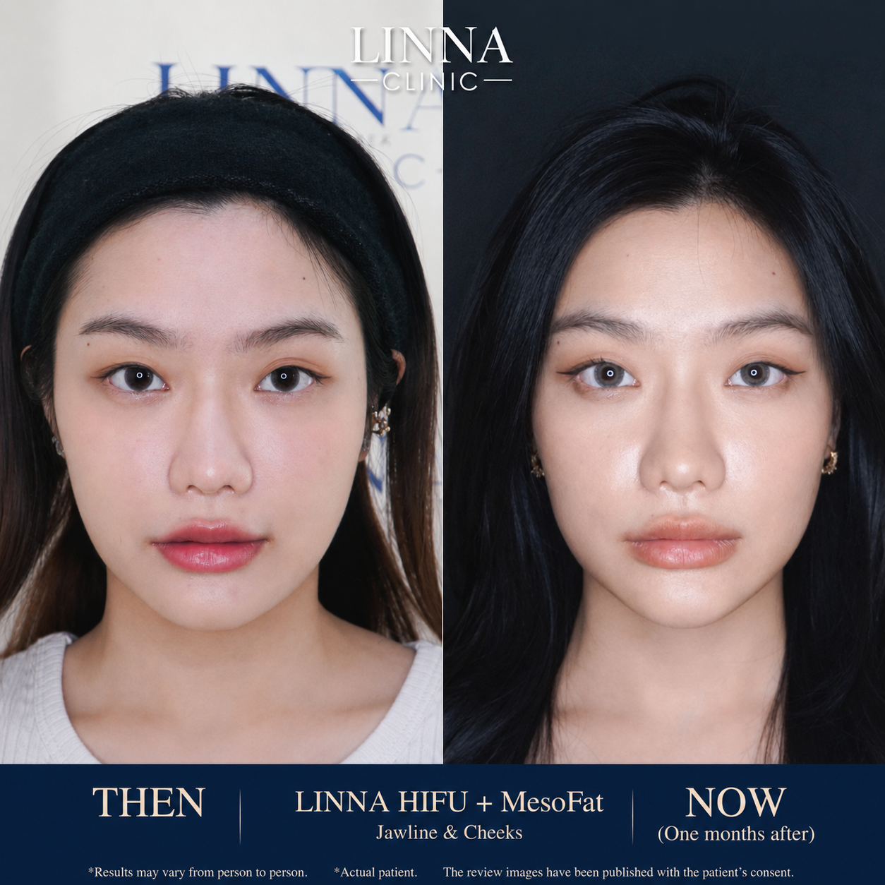 LINNA Clinic treatment result