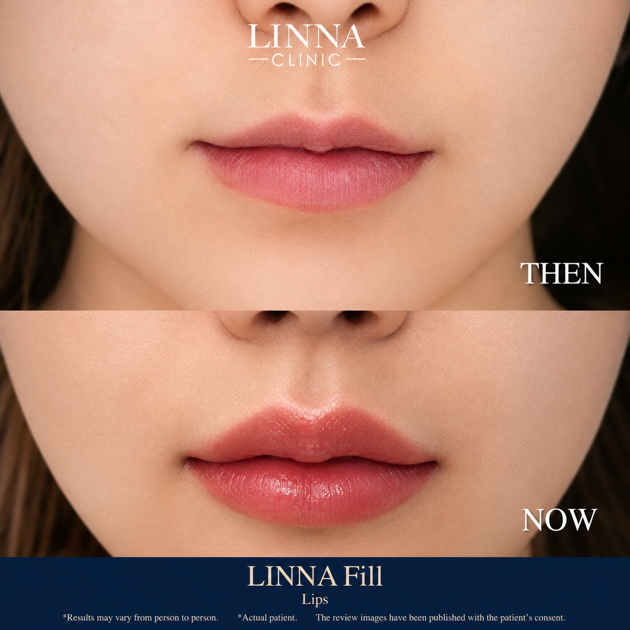 Lip filler before and after result at LINNA Clinic