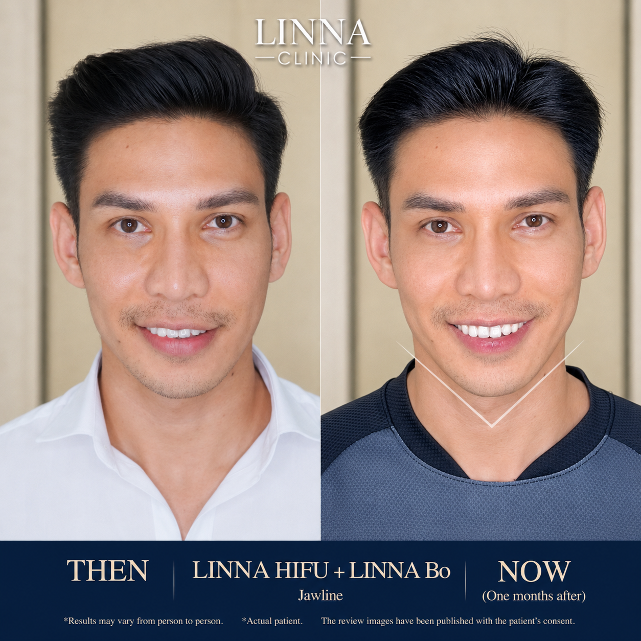 LINNA Clinic โปรแกรมโบ ช่วยลดริ้วรอย ปรับรูปหน้าและรูปคิ้ว ไม่มีผลข้างเคียงและไม่ทิ้งสารตกค้างภายในร่างกาย
