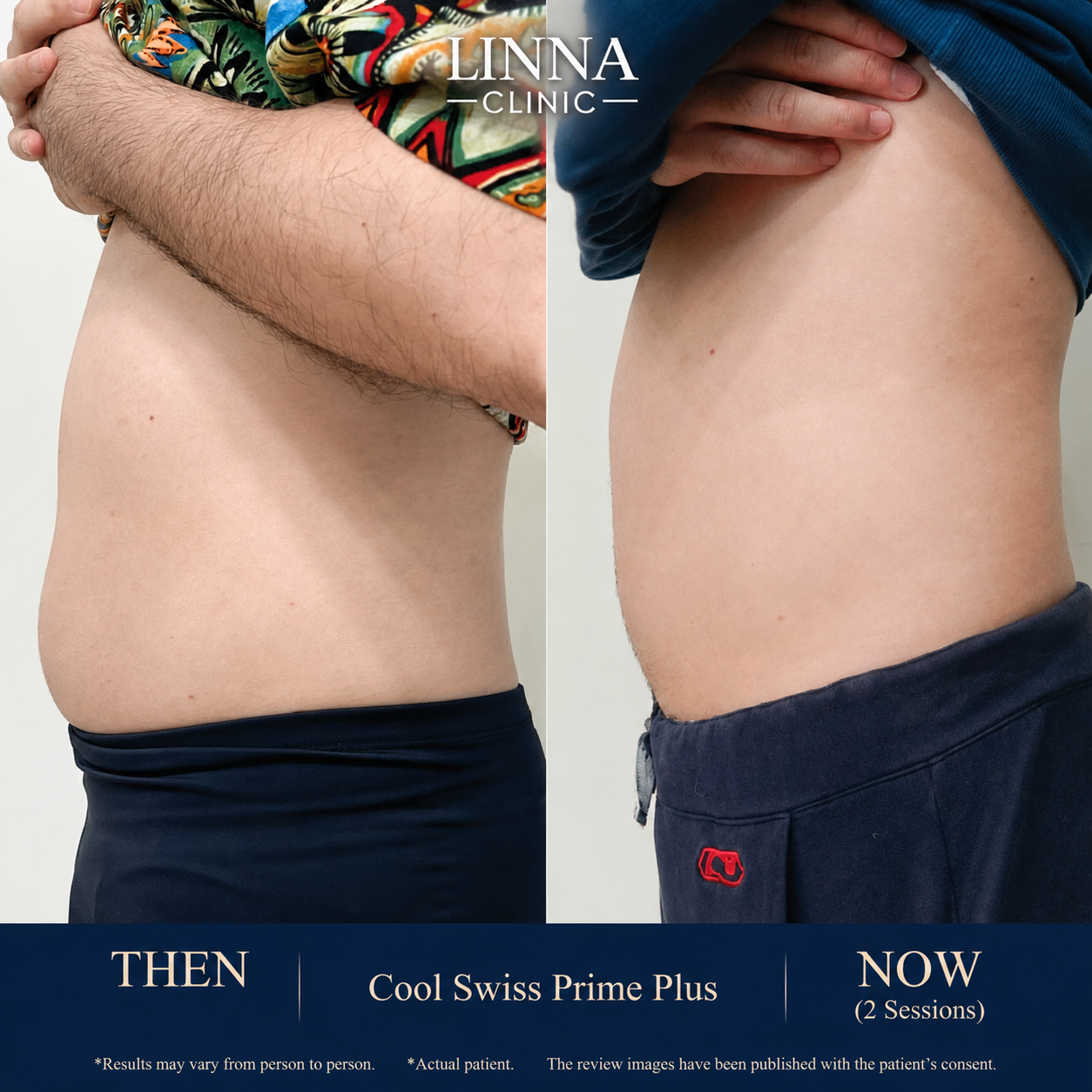 Cool Swiss Prime Plus before and after