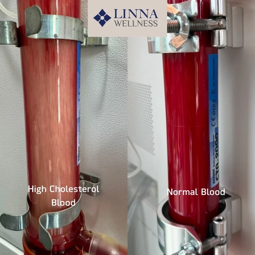 Ozone Therapy (EBOO PLUS Technique) at LINNA Clinic
