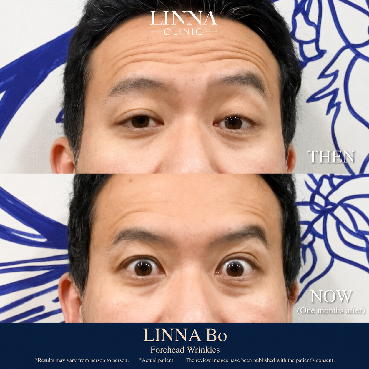 LINNA Clinic โปรแกรมโบ ช่วยลดริ้วรอย ปรับรูปหน้าและรูปคิ้ว ไม่มีผลข้างเคียงและไม่ทิ้งสารตกค้างภายในร่างกายอ