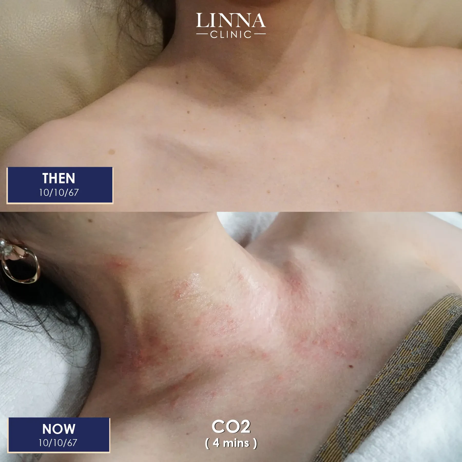 รีวิว Co2 Laser ก่อนและหลัง