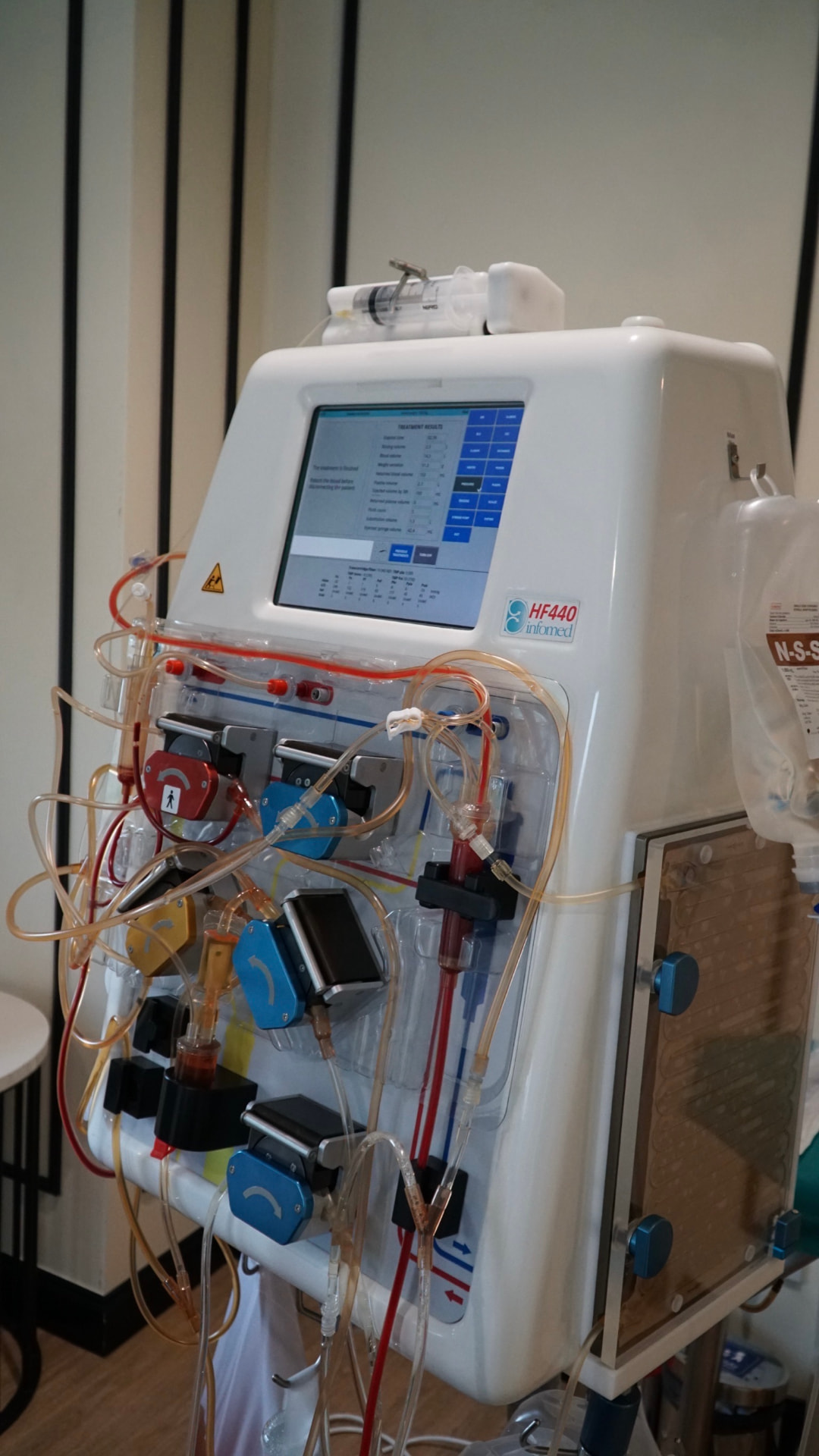 What Is DFPP (Plasmapheresis), and How Can It Help Reduce Heavy Metals and Toxins Accumulated in the Body?