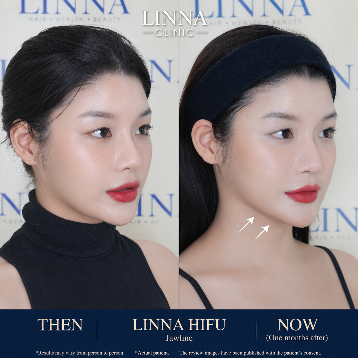 LINNA Clinic treatment result