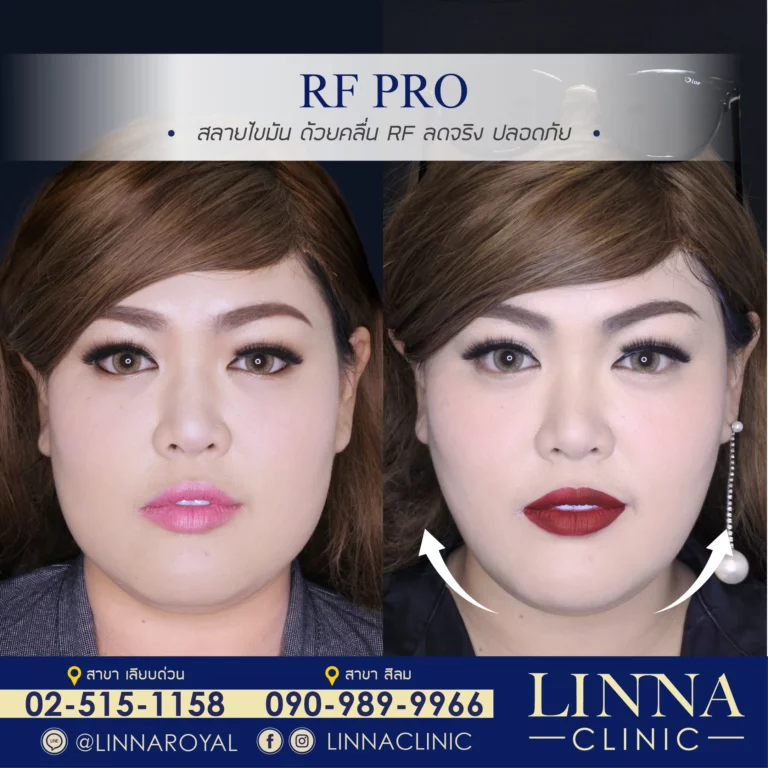 LINNA RF Pro device at LINNA Clinic