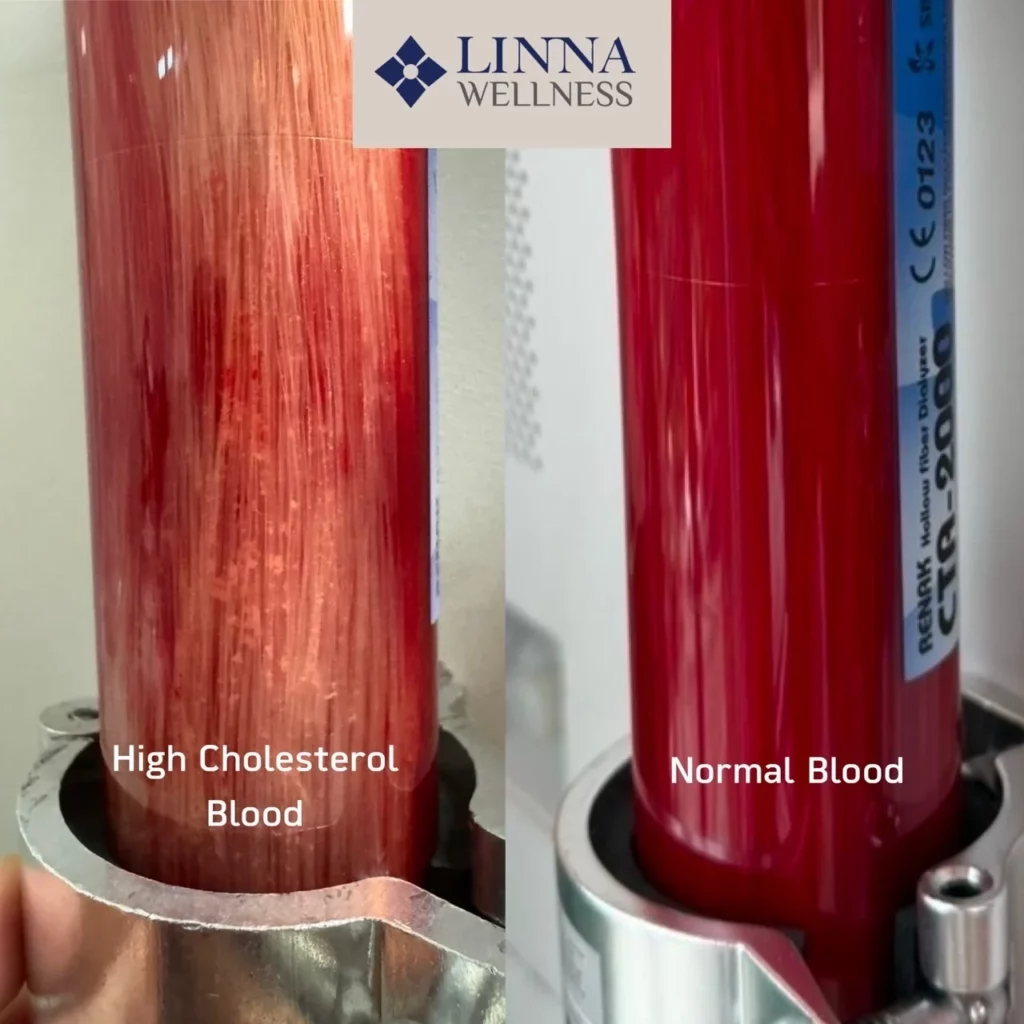 Ozone Therapy (EBOO PLUS Technique) at LINNA Clinic