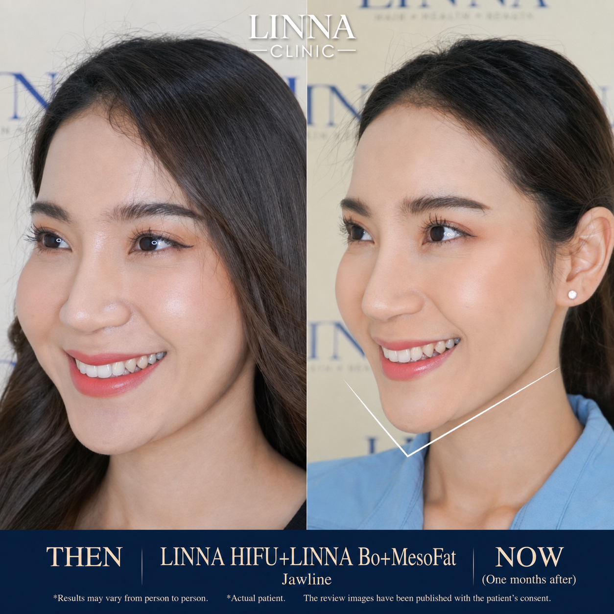 LINNA Clinic โปรแกรมโบ ช่วยลดริ้วรอย ปรับรูปหน้าและรูปคิ้ว ไม่มีผลข้างเคียงและไม่ทิ้งสารตกค้างภายในร่างกาย