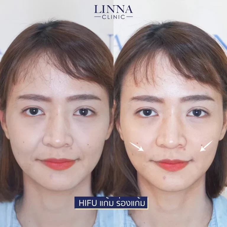 11 ข้อควรรู้ก่อนทำไฮฟู่ (Hifu) การรักษาความงามแบบไม่ต้องผ่าตัด