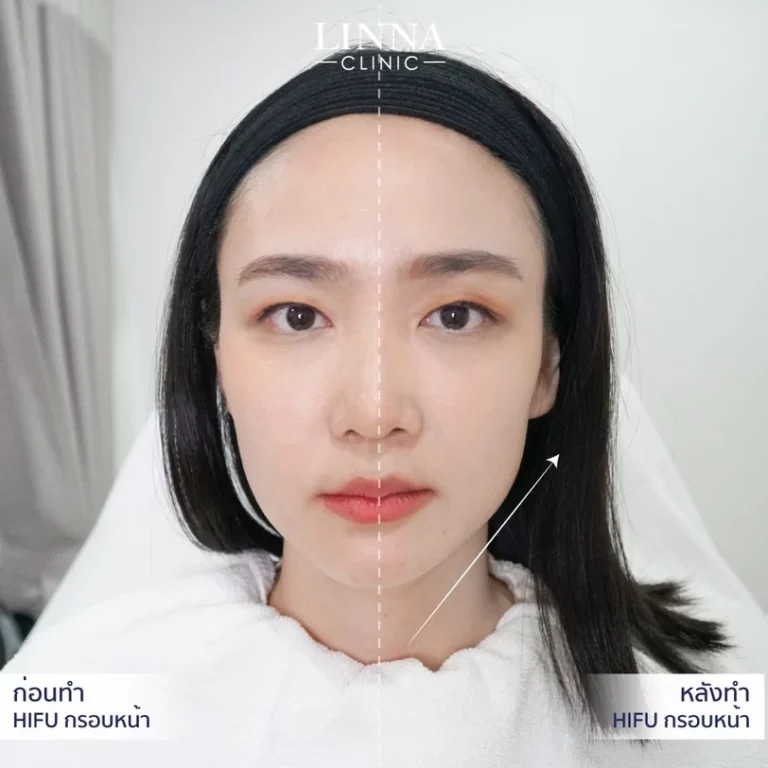 11 ข้อควรรู้ก่อนทำไฮฟู่ (Hifu) การรักษาความงามแบบไม่ต้องผ่าตัด