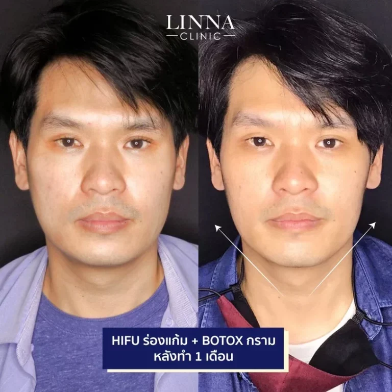 11 ข้อควรรู้ก่อนทำไฮฟู่ (Hifu) การรักษาความงามแบบไม่ต้องผ่าตัด