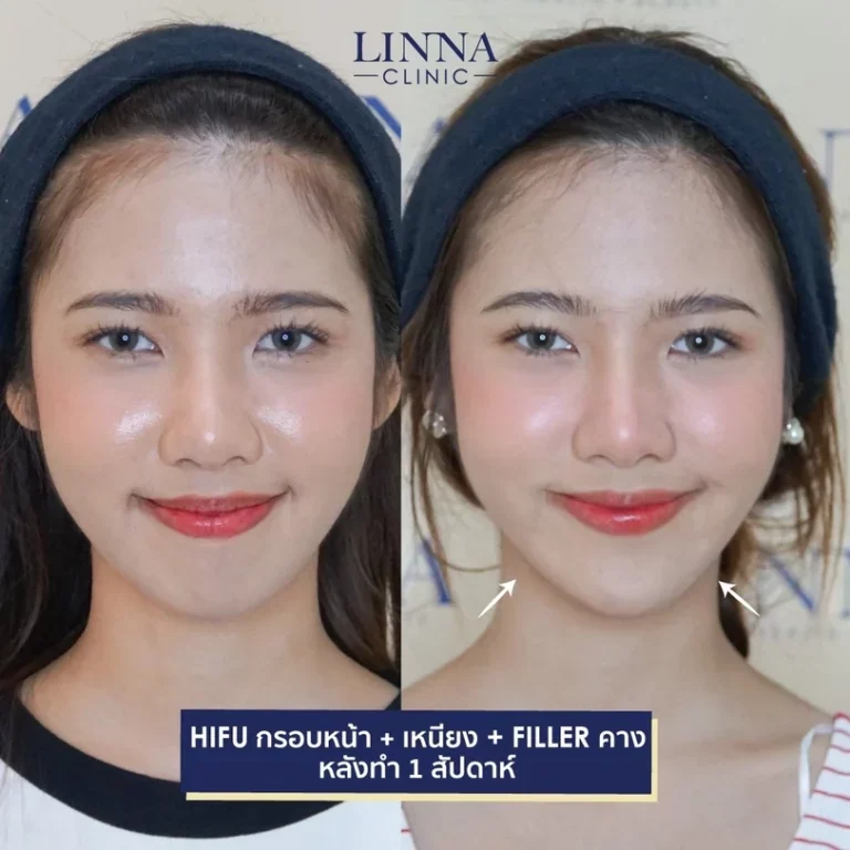 11 ข้อควรรู้ก่อนทำไฮฟู่ (Hifu) การรักษาความงามแบบไม่ต้องผ่าตัด