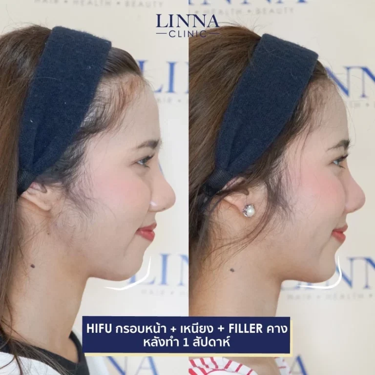 11 ข้อควรรู้ก่อนทำไฮฟู่ (Hifu) การรักษาความงามแบบไม่ต้องผ่าตัด