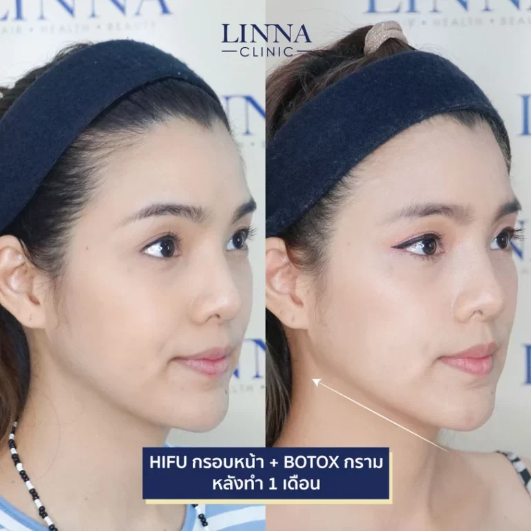 11 ข้อควรรู้ก่อนทำไฮฟู่ (Hifu) การรักษาความงามแบบไม่ต้องผ่าตัด
