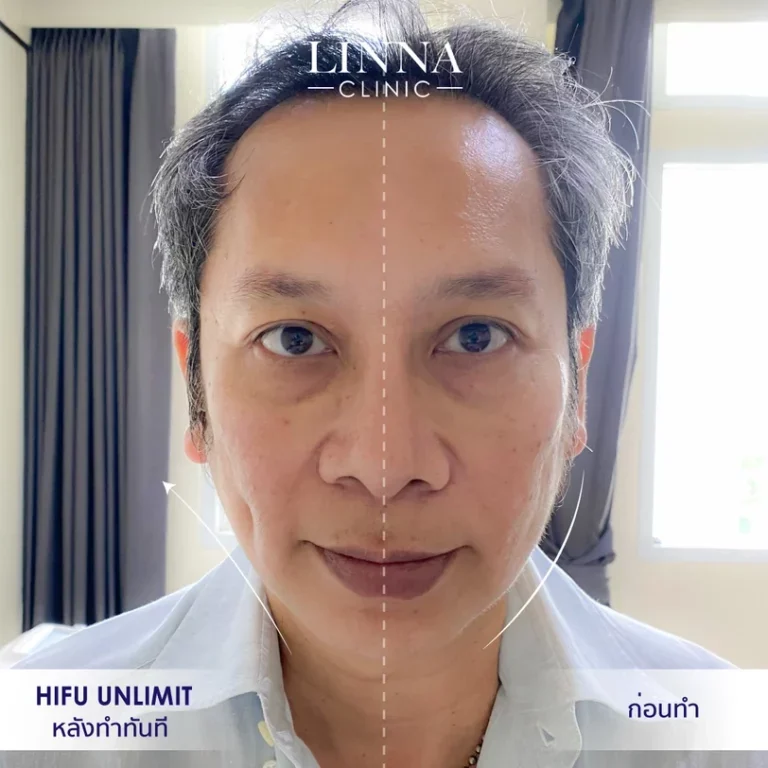 11 ข้อควรรู้ก่อนทำไฮฟู่ (Hifu) การรักษาความงามแบบไม่ต้องผ่าตัด