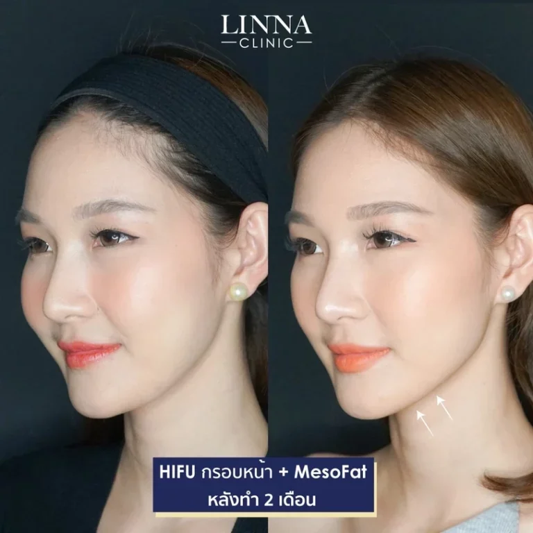 11 ข้อควรรู้ก่อนทำไฮฟู่ (Hifu) การรักษาความงามแบบไม่ต้องผ่าตัด