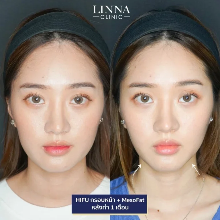11 ข้อควรรู้ก่อนทำไฮฟู่ (Hifu) การรักษาความงามแบบไม่ต้องผ่าตัด