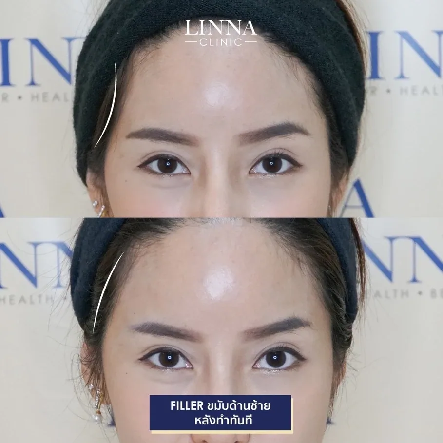 4 วิธีแก้แก้มตอบ ทวงคืนใบหน้าที่สดชื่นเปล่งปลั่ง !