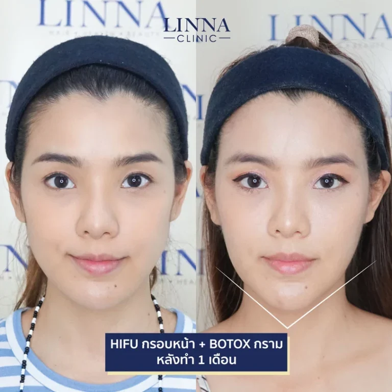 6 ความแตกต่างระหว่าง Ulthera และ Hifu แบบไหนดีกว่ากัน