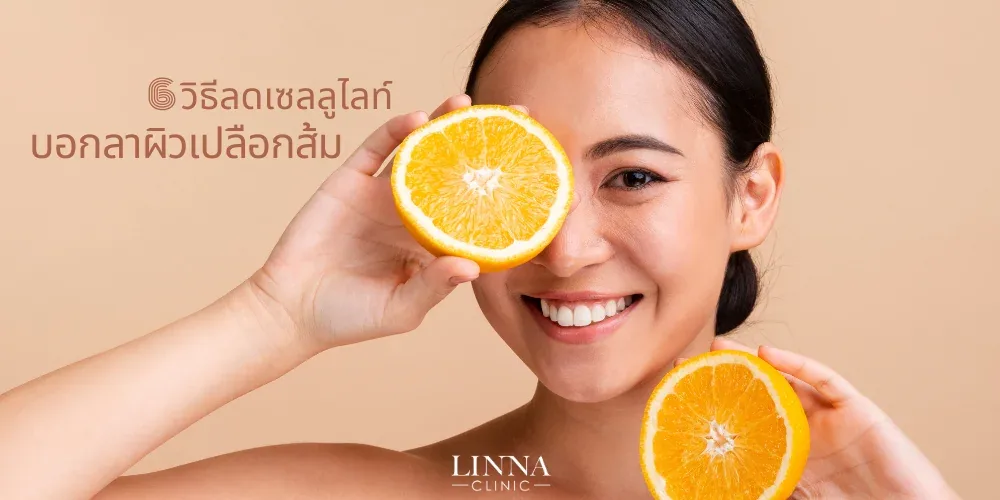 6 วิธีลดเซลลูไลท์ สลายเซลลูไลท์ บอกลาผิวเปลือกส้ม