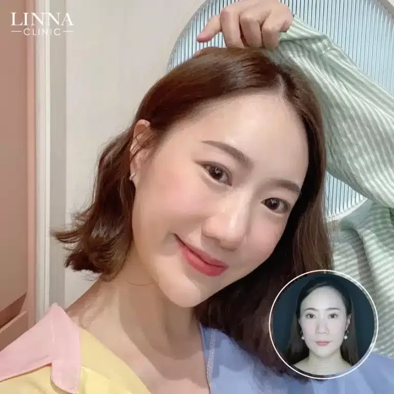8 ความแตกต่าง LINNA HIFU vs Ultraformer ต่างกันอย่างไร