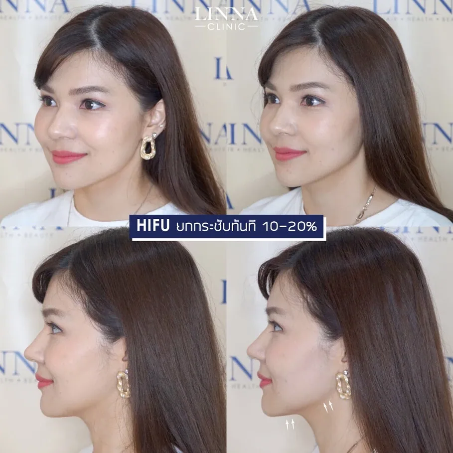 HIFU ราคาถูก ราคาแพง ผลต่างกันไหม แพงแล้วดีกว่าจริงไหม
