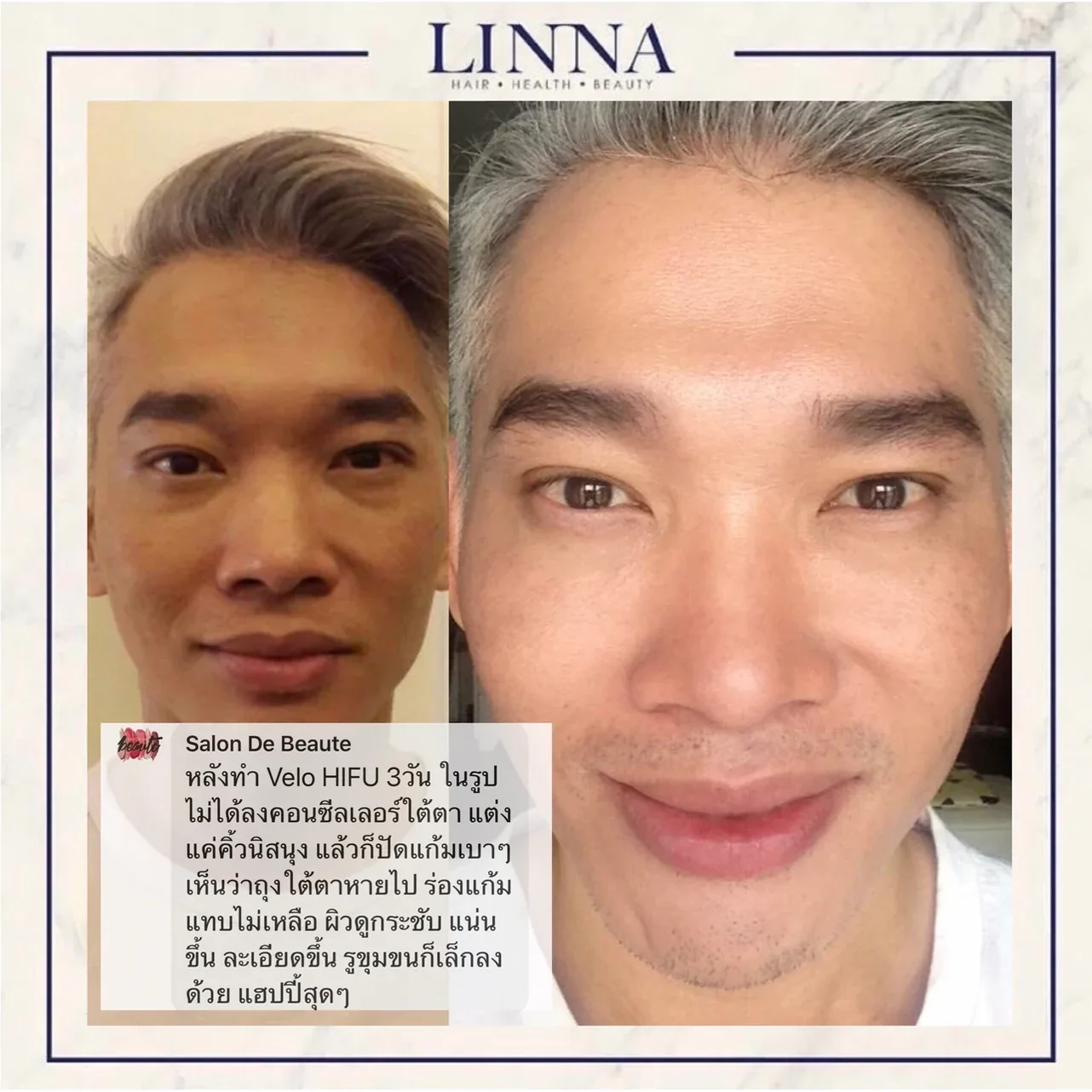 LINNA Clinic HIFU 8D คือนวัตกรรมการยกกระชับใบหน้าและร่างกายแบบไม่เจ็บจากเกาหลี