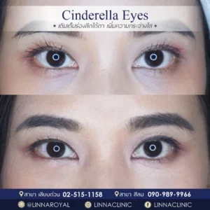 Cinderella Eyes ตัวเลือกใหม่สำหรับคนมีปัญหารอยคล้ำใต้ตา