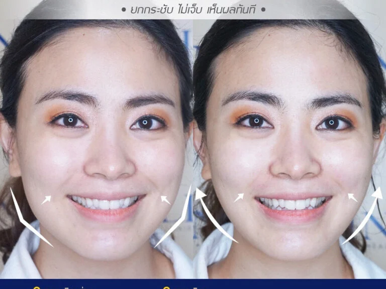มีร่องแก้มลึก แก้ยังไงได้บ้าง