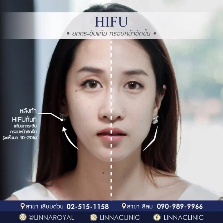 ทำ Hifu ต้องเจ็บหรือไม่เจ็บ ช่วยยกกระชับได้จริงไหม